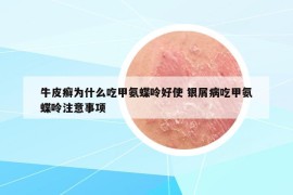 牛皮癣为什么吃甲氨蝶呤好使 银屑病吃甲氨蝶呤注意事项