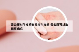 雷公藤对牛皮癣有能治牛皮癣 雷公藤可以治银屑病吗