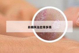 白癜风治愈得多钱