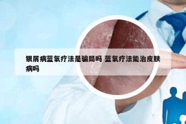 银屑病蓝氧疗法是骗局吗 蓝氧疗法能治皮肤病吗