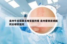 泉州牛皮癣要去哪家医院看 泉州看银屑病医院去哪家医院