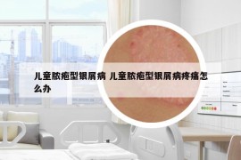 儿童脓疱型银屑病 儿童脓疱型银屑病疼痛怎么办