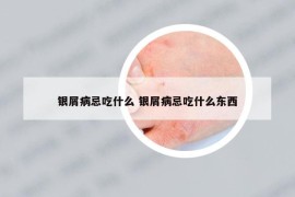 银屑病忌吃什么 银屑病忌吃什么东西