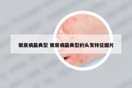 银屑病最典型 银屑病最典型的头发特征图片