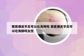 银屑病关节炎可以吃海鲜吗 银屑病关节炎可以吃海鲜吗女性