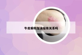 牛皮癣和加油站有关系吗