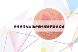 治疗癣得方法 治疗癣有哪些药膏比较好