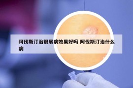 阿伐斯汀治银屑病效果好吗 阿伐斯汀治什么病