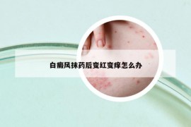 白癜风抹药后变红变痒怎么办