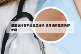 银屑病排毒不能靠尿液吗 银屑病用尿清洗好使吗