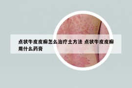 点状牛皮皮癣怎么治疗土方法 点状牛皮皮癣用什么药膏