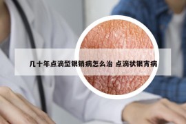 几十年点滴型银销病怎么治 点滴状银宵病