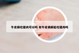 牛皮癣吃猪肉可以吗 有牛皮病癣能吃猪肉吗