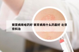 银霄病用啥药好 银宵病用什么药最好 北京京科治