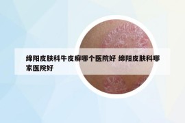 绵阳皮肤科牛皮癣哪个医院好 绵阳皮肤科哪家医院好