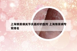 上海银屑病关节炎最好的医院 上海银屑病专家排名