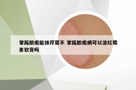 掌跖脓疱能抹芹菜不 掌跖脓疱病可以涂红霉素软膏吗