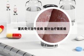 董氏奇穴治牛皮癣 董针治疗银屑病