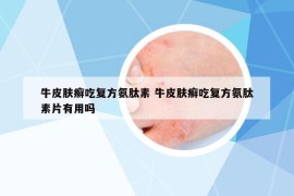 牛皮肤癣吃复方氨肽素 牛皮肤癣吃复方氨肽素片有用吗