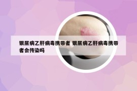 银屑病乙肝病毒携带者 银屑病乙肝病毒携带者会传染吗