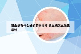 银血病有什么好的药物治疗 银血病怎么效果最好