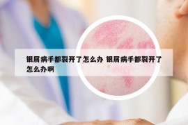 银屑病手都裂开了怎么办 银屑病手都裂开了怎么办啊