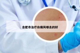 合肥市治疗白癜风哪去的好