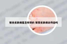 银肖皮肤病是怎样得的 银霄皮肤病会传染吗