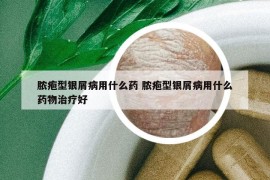 脓疱型银屑病用什么药 脓疱型银屑病用什么药物治疗好