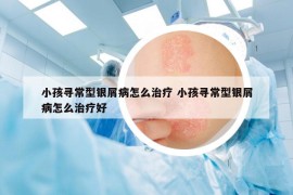 小孩寻常型银屑病怎么治疗 小孩寻常型银屑病怎么治疗好