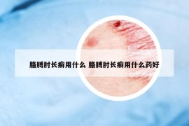 胳膊肘长癣用什么 胳膊肘长癣用什么药好