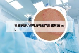 银屑病照UVB有没有副作用 银屑病 uvb