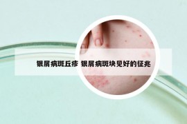 银屑病斑丘疹 银屑病斑块见好的征兆