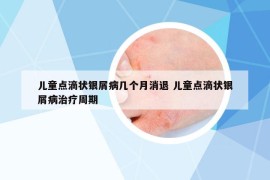 儿童点滴状银屑病几个月消退 儿童点滴状银屑病治疗周期