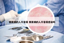 银屑病的人不容易 银屑病的人不容易感染吗