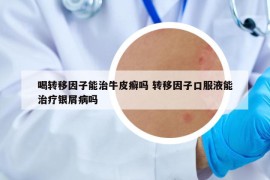 喝转移因子能治牛皮癣吗 转移因子口服液能治疗银屑病吗