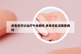 虎毒膏可以治疗牛皮癣吗 虎毒膏能活银屑病吗