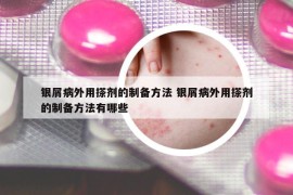 银屑病外用搽剂的制备方法 银屑病外用搽剂的制备方法有哪些