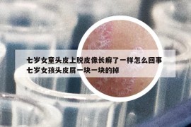 七岁女童头皮上脱皮像长癣了一样怎么回事 七岁女孩头皮屑一块一块的掉