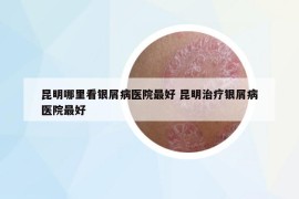 昆明哪里看银屑病医院最好 昆明治疗银屑病医院最好