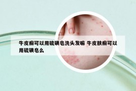 牛皮癣可以用硫磺皂洗头发嘛 牛皮肤癣可以用硫磺皂么