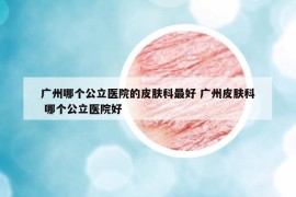 广州哪个公立医院的皮肤科最好 广州皮肤科 哪个公立医院好