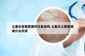 儿童头皮银屑病可以自愈吗 儿童头上银屑病用什么药膏