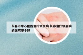 长春市中心医院治疗银屑病 长春治疗银屑病的医院哪个好