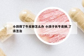 小孩得了牛皮鲜怎么办 小孩子长牛皮鲜,了该怎治