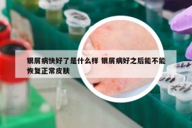 银屑病快好了是什么样 银屑病好之后能不能恢复正常皮肤