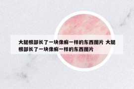 大腿根部长了一块像癣一样的东西图片 大腿根部长了一块像癣一样的东西图片