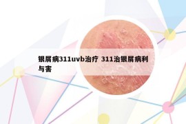 银屑病311uvb治疗 311治银屑病利与害