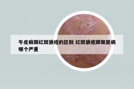 牛皮癣跟红斑狼疮的区别 红斑狼疮跟银屑病哪个严重