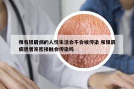 和有银屑病的人性生活会不会被传染 和银屑病患者亲密接触会传染吗